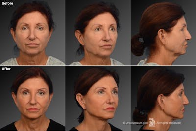 Face and Neck Lift Before & After Gallery - Patient 106009211 - Image 1