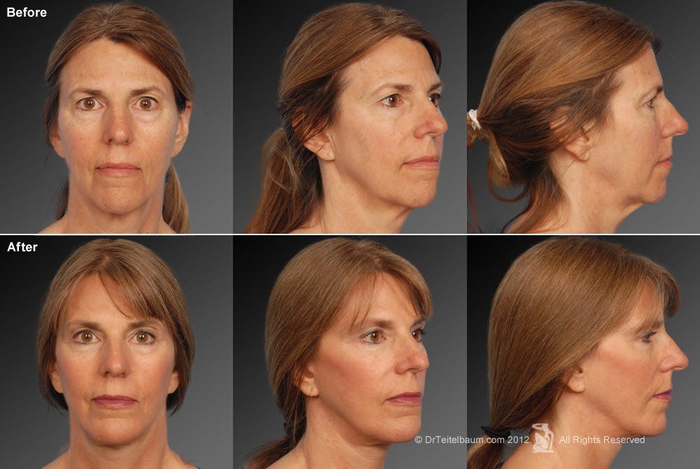 Face and Neck Lift Before & After Gallery - Patient 106009212 - Image 1