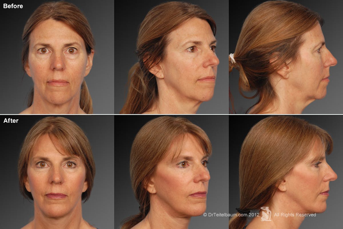 Face and Neck Lift Before & After Gallery - Patient 106009212 - Image 1