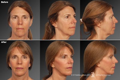 Face and Neck Lift Before & After Gallery - Patient 106009212 - Image 1