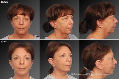 Face and Neck Lift Before & After Gallery - Patient 106009215 - Image 1