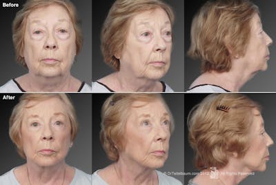 Face and Neck Lift Before & After Gallery - Patient 106009216 - Image 1