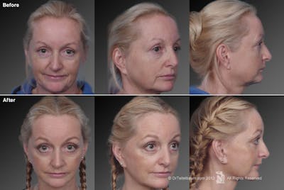Face and Neck Lift Before & After Gallery - Patient 106009218 - Image 1