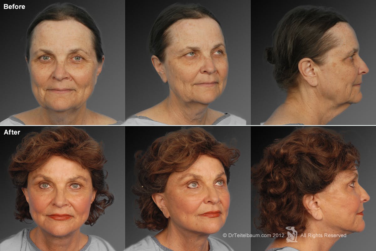 Face and Neck Lift Before & After Gallery - Patient 106009221 - Image 1