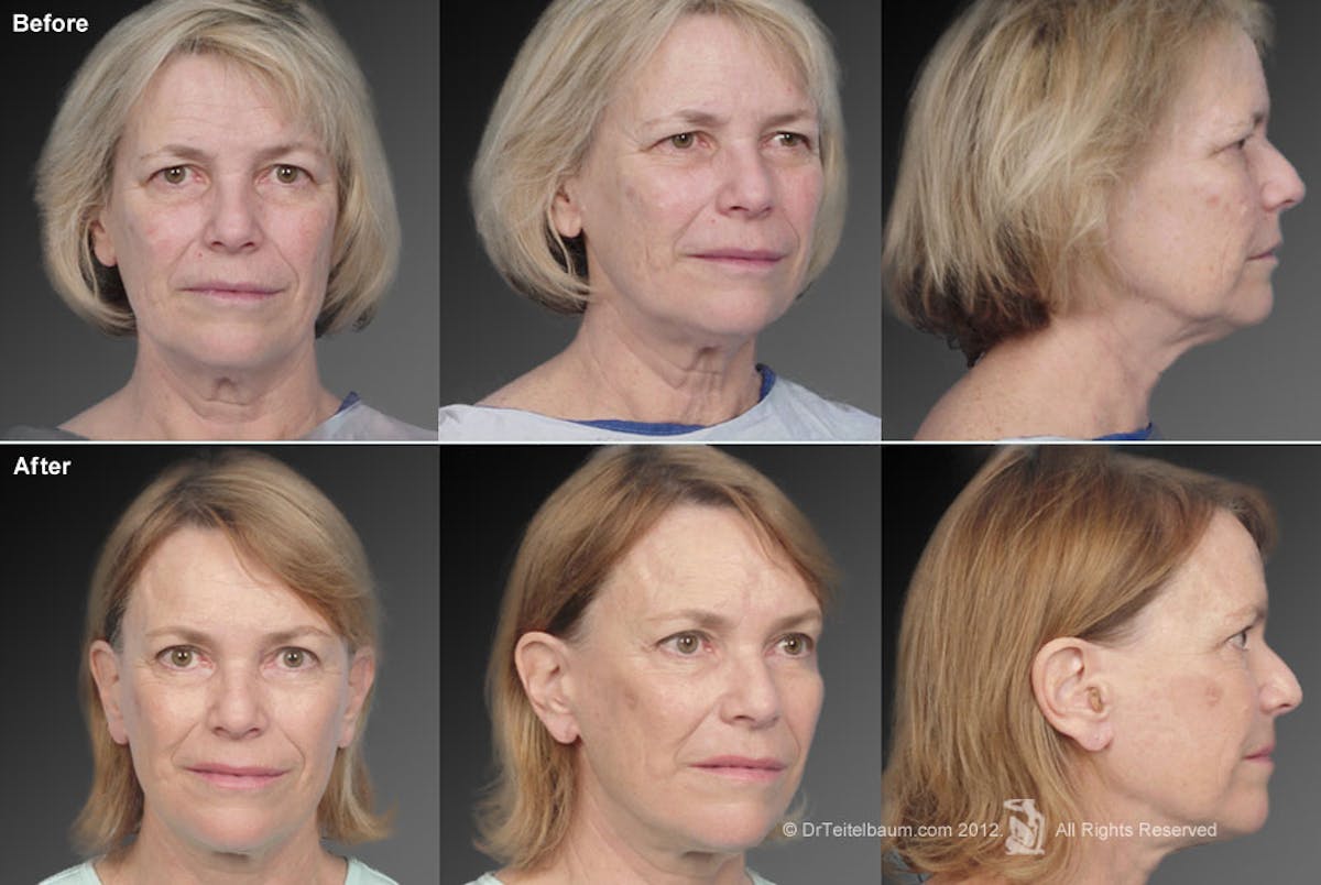 Face and Neck Lift Before & After Gallery - Patient 106009222 - Image 1