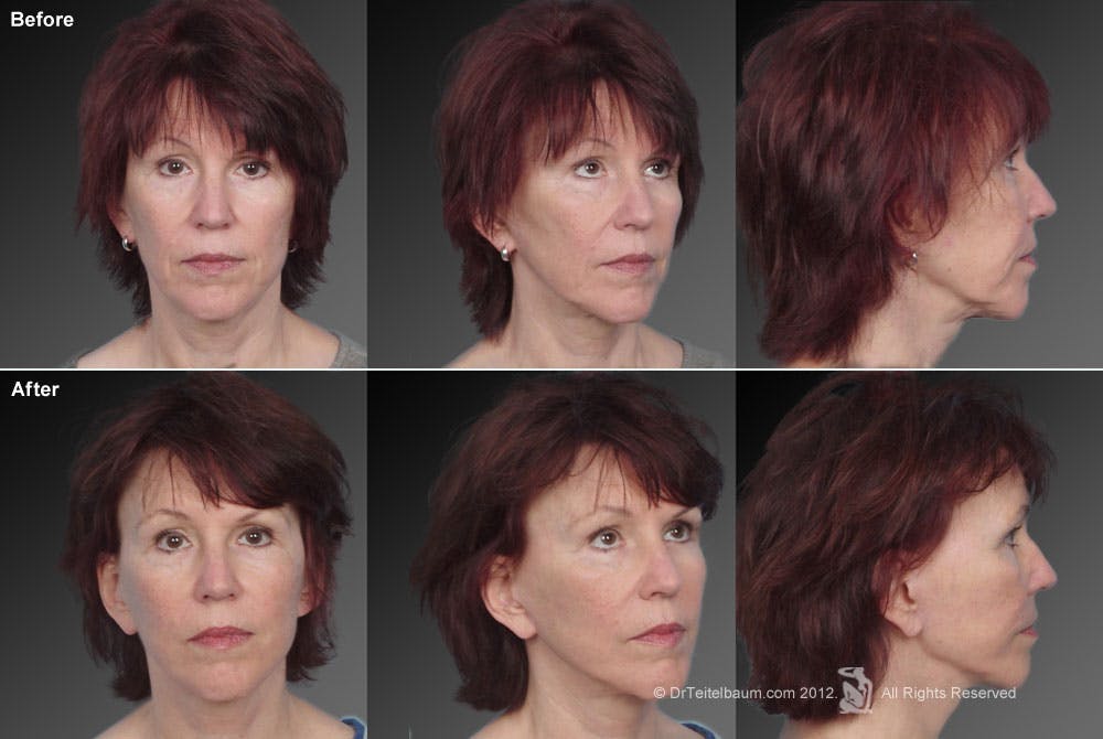 Face and Neck Lift Before & After Gallery - Patient 106009223 - Image 1