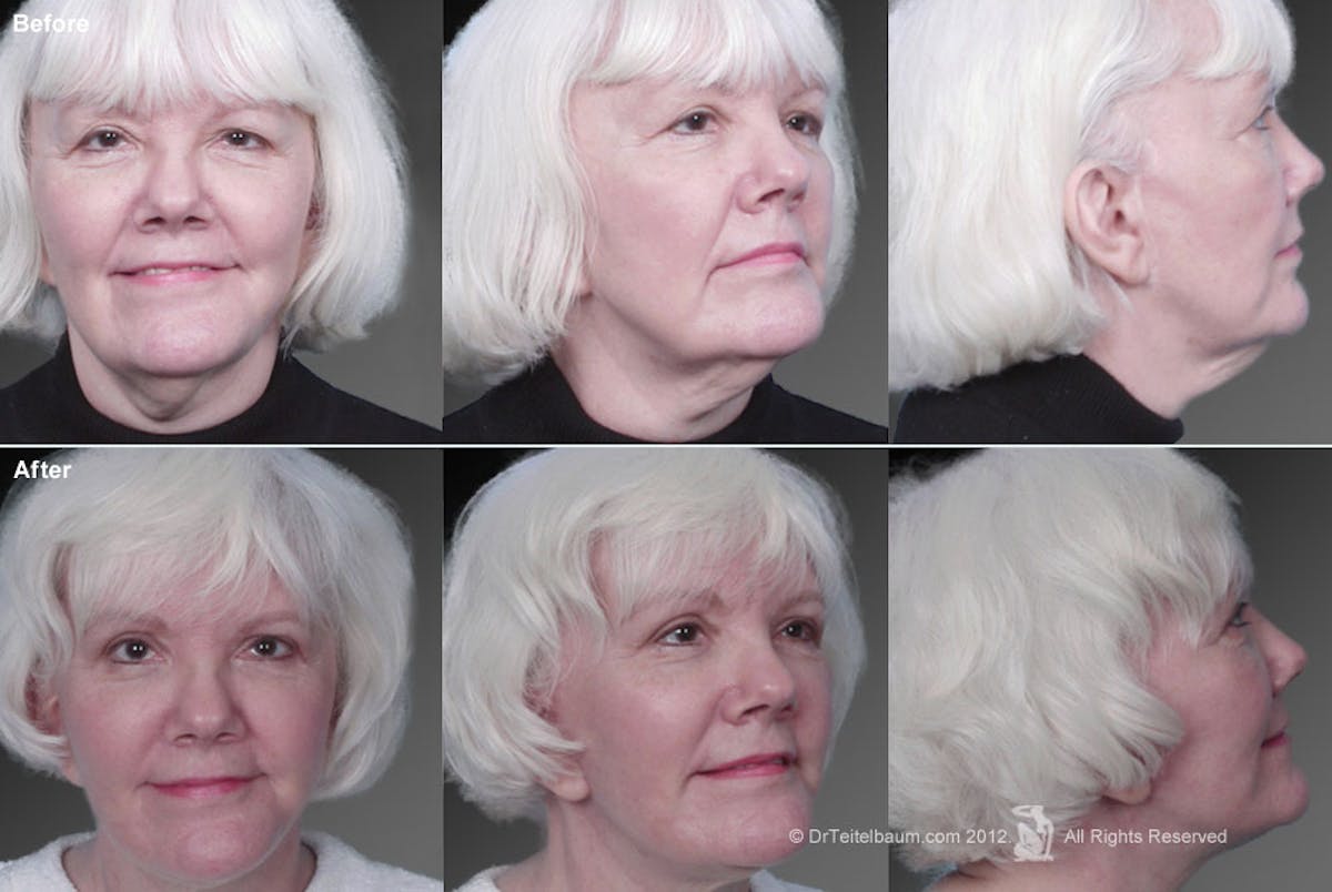 Face and Neck Lift Before & After Gallery - Patient 106009224 - Image 1