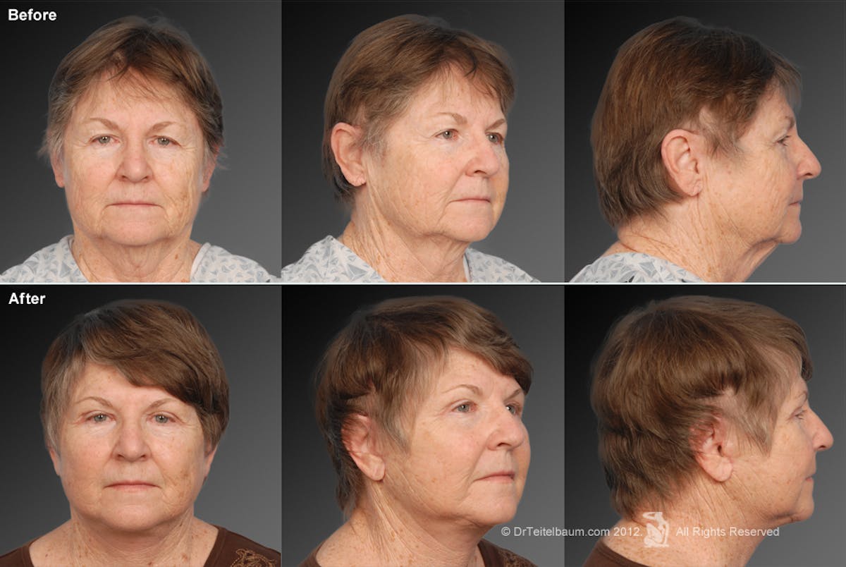 Face and Neck Lift Before & After Gallery - Patient 106009231 - Image 1