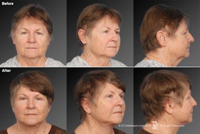 Face and Neck Lift Before & After Gallery - Patient 106009231 - Image 1