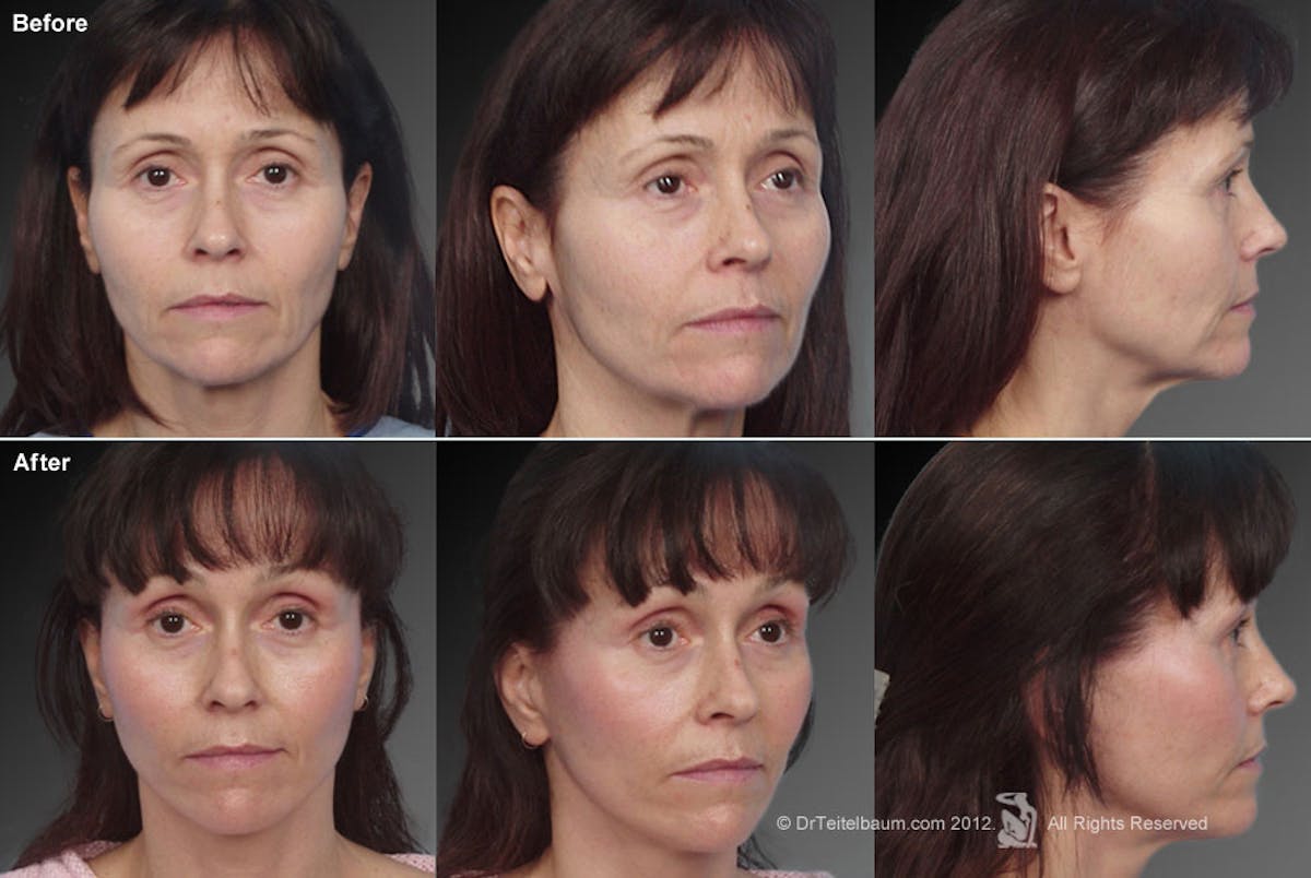 Face and Neck Lift Before & After Gallery - Patient 106009232 - Image 1