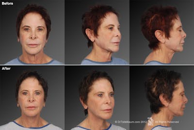 Face and Neck Lift Before & After Gallery - Patient 106009233 - Image 1