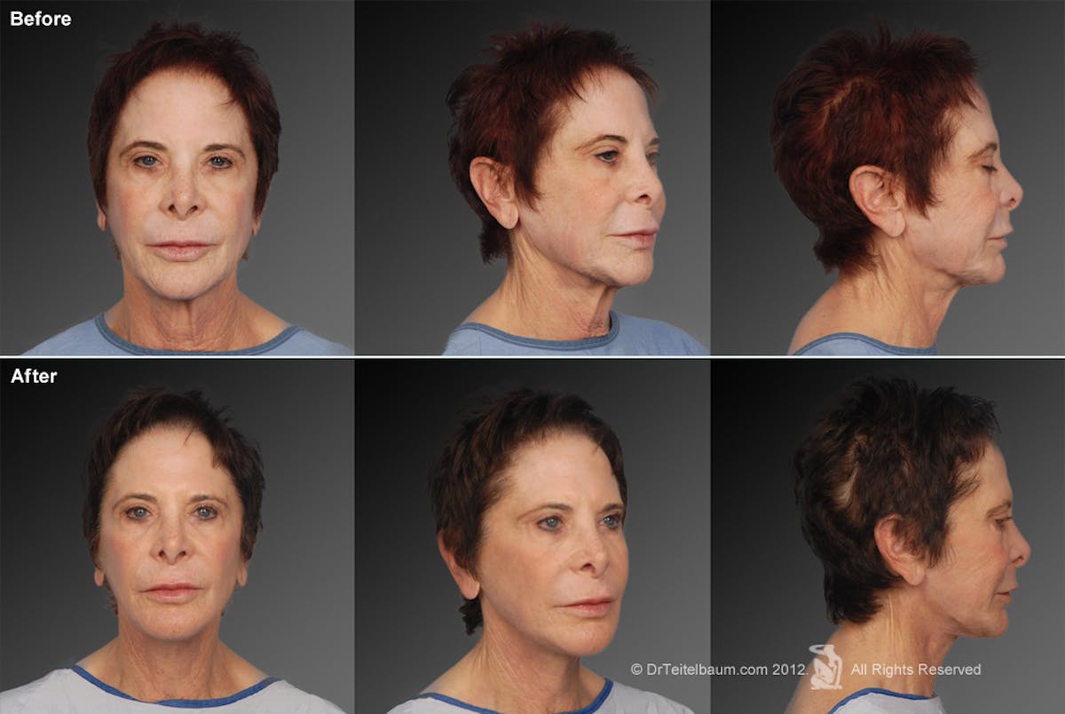 Face and Neck Lift Before & After Gallery - Patient 106009233 - Image 1