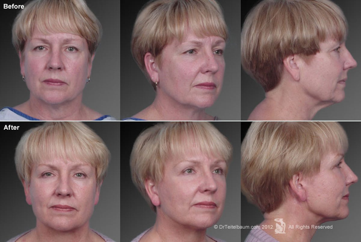 Face and Neck Lift Before & After Gallery - Patient 106009234 - Image 1