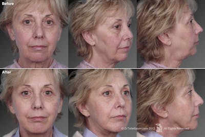 Face and Neck Lift Before & After Gallery - Patient 106009235 - Image 1
