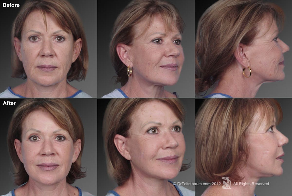 Face and Neck Lift Before & After Gallery - Patient 106009237 - Image 1
