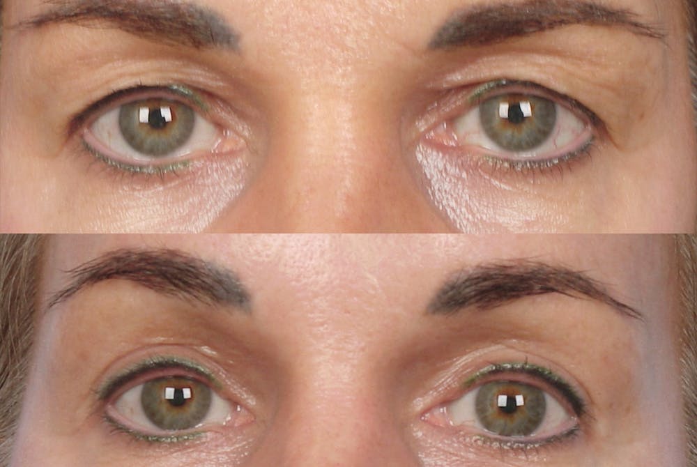 Eyelift Before & After Gallery - Patient 106009242 - Image 1