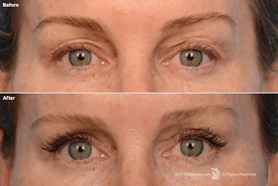 Eyelift Before & After Gallery - Patient 106009243 - Image 1