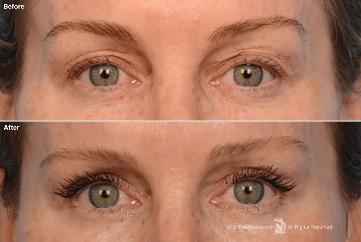 Eyelift Before & After Gallery - Patient 106009243 - Image 1