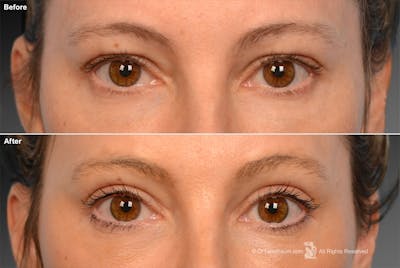 Eyelift Before & After Gallery - Patient 106009247 - Image 1
