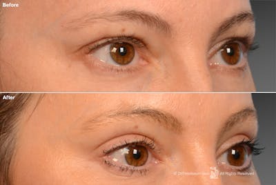 Eyelift Before & After Gallery - Patient 106009248 - Image 1