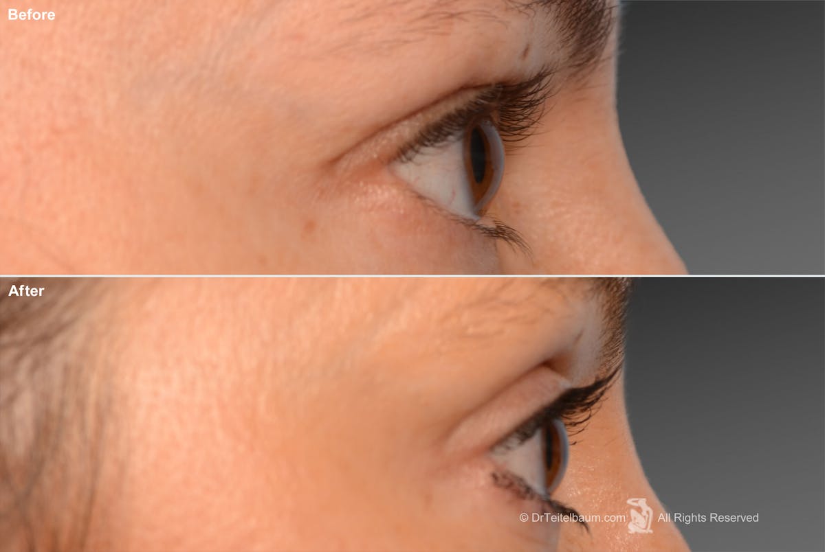 Eyelift Before & After Gallery - Patient 106009250 - Image 1