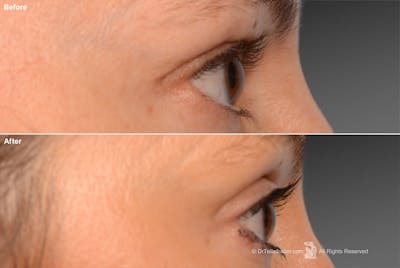 Eyelift Before & After Gallery - Patient 106009250 - Image 1
