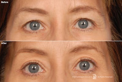 Eyelift Before & After Gallery - Patient 106009252 - Image 1