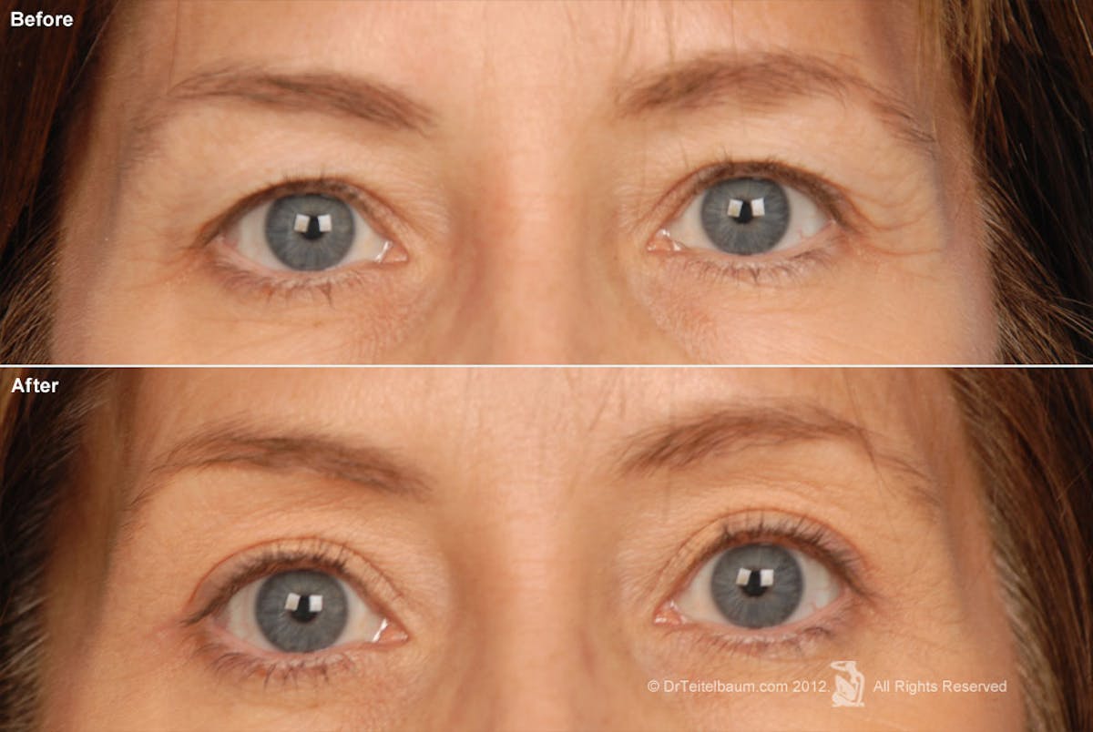 Eyelift Before & After Gallery - Patient 106009252 - Image 1
