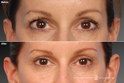 Eyelift Before & After Gallery - Patient 106009253 - Image 1