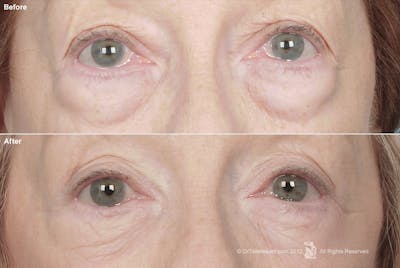 Eyelift Before & After Gallery - Patient 106009254 - Image 1
