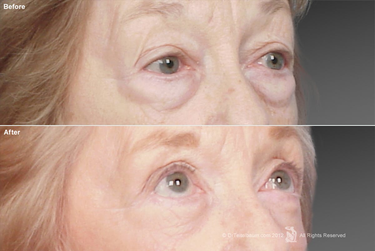 Eyelift Before & After Gallery - Patient 106009256 - Image 1