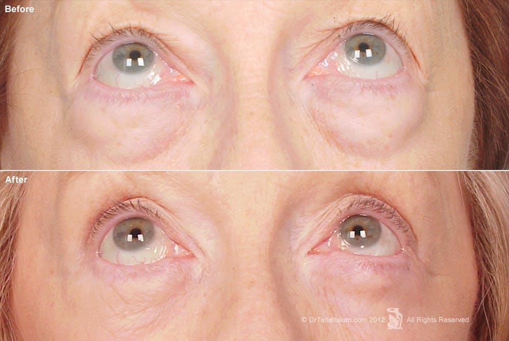 Eyelift Before & After Gallery - Patient 106009257 - Image 1