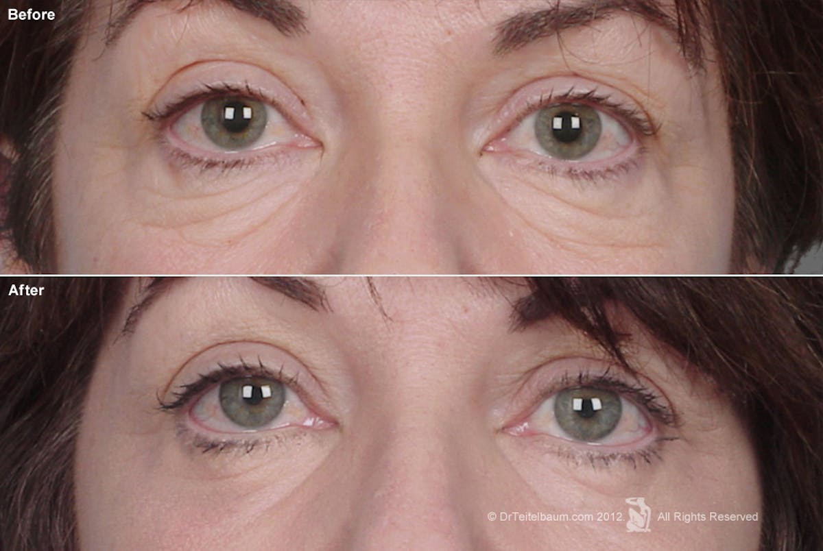 Eyelift Before & After Gallery - Patient 106009259 - Image 1