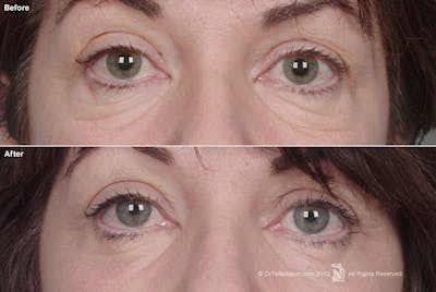 Eyelift Before & After Gallery - Patient 106009259 - Image 1