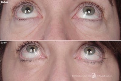 Eyelift Before & After Gallery - Patient 106009260 - Image 1