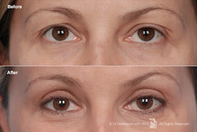 Eyelift Before & After Gallery - Patient 106009261 - Image 1