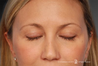 Eyelift Before & After Gallery - Patient 106009262 - Image 1