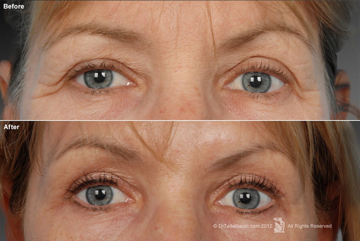 Eyelift Before & After Gallery - Patient 106009263 - Image 1