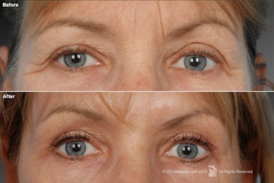 Eyelift Before & After Gallery - Patient 106009263 - Image 1