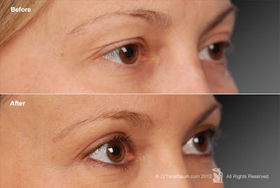 Eyelift Before & After Gallery - Patient 106009264 - Image 1