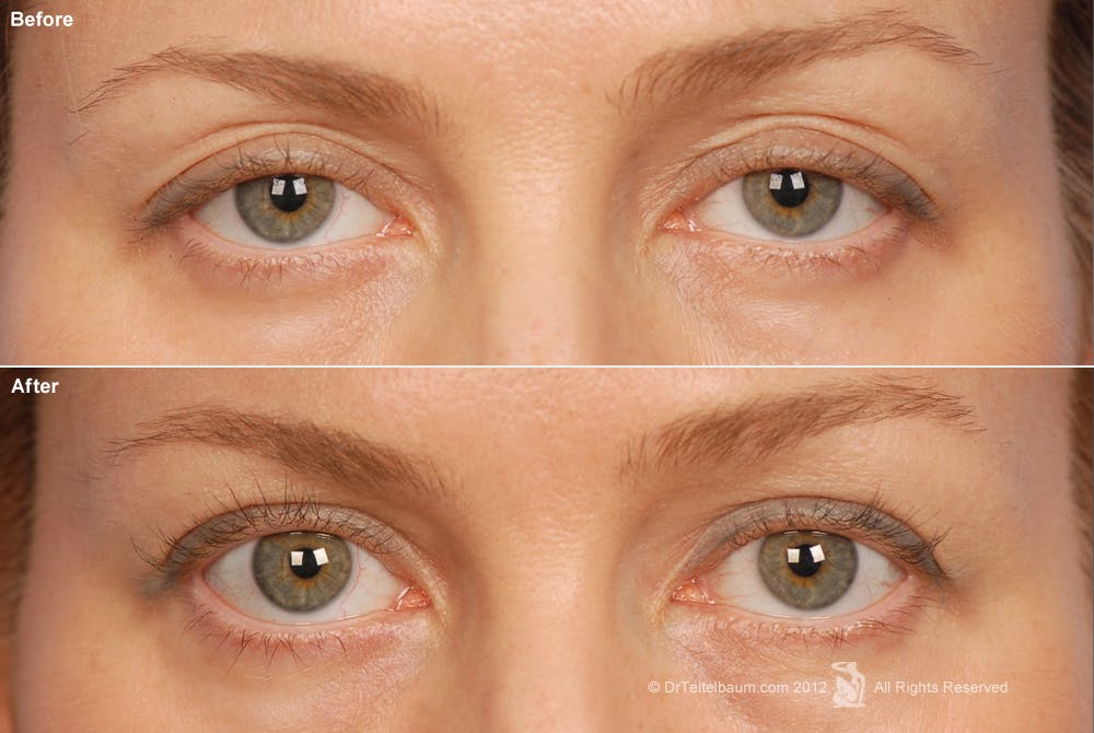 Eyelift Before & After Gallery - Patient 106009267 - Image 1
