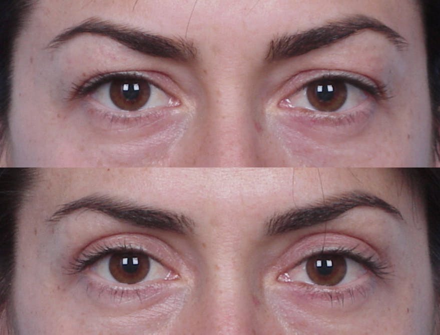 Eyelift Before & After Gallery - Patient 106009269 - Image 1