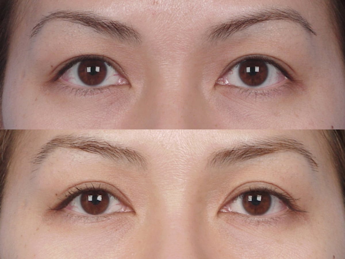 Eyelift Before & After Gallery - Patient 106009270 - Image 1