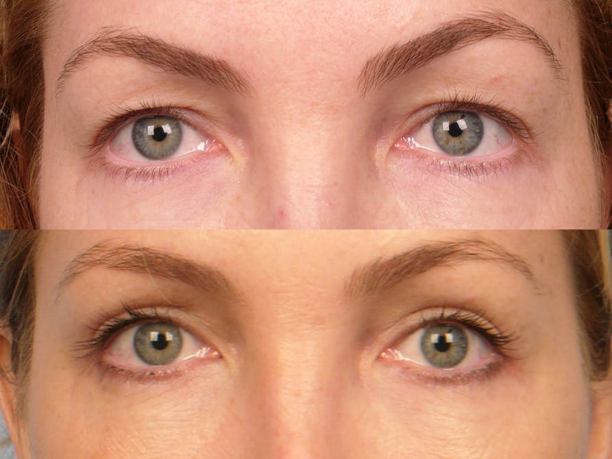 Eyelift Before & After Gallery - Patient 106009271 - Image 1