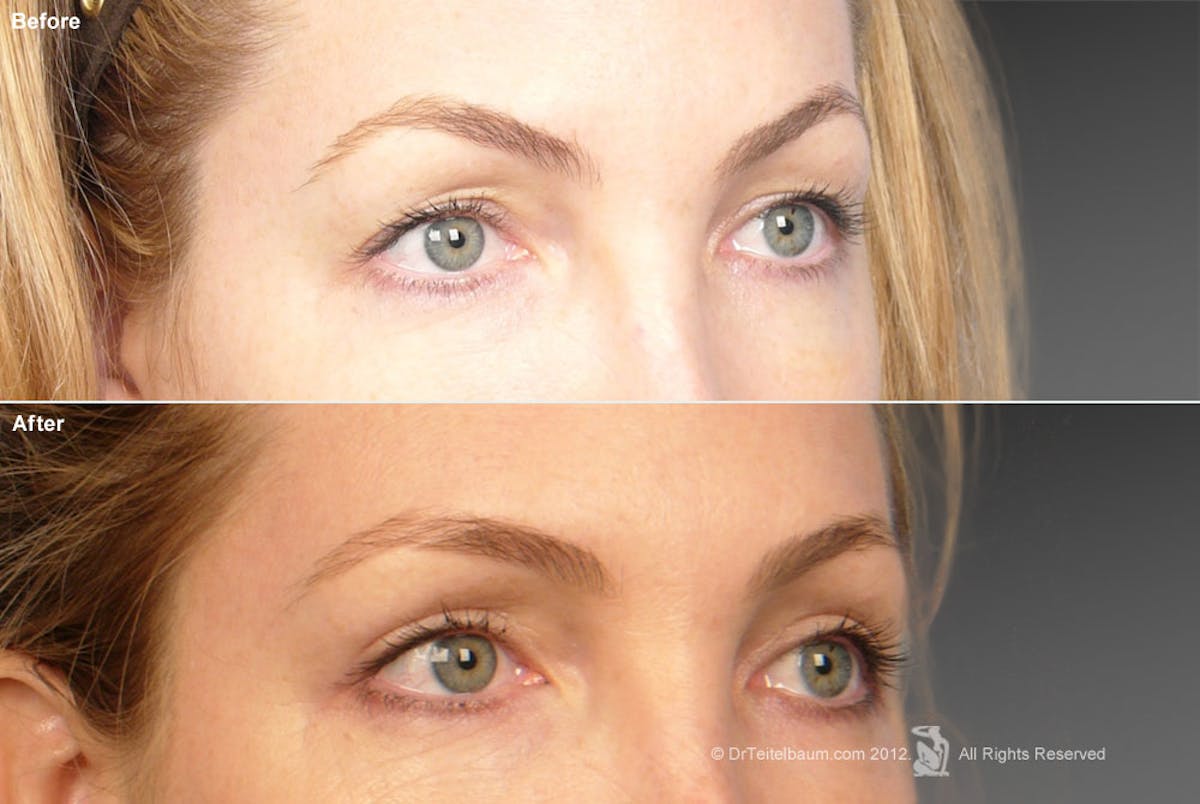 Eyelift Before & After Gallery - Patient 106009272 - Image 1