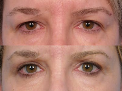 Eyelift Before & After Gallery - Patient 106009273 - Image 1