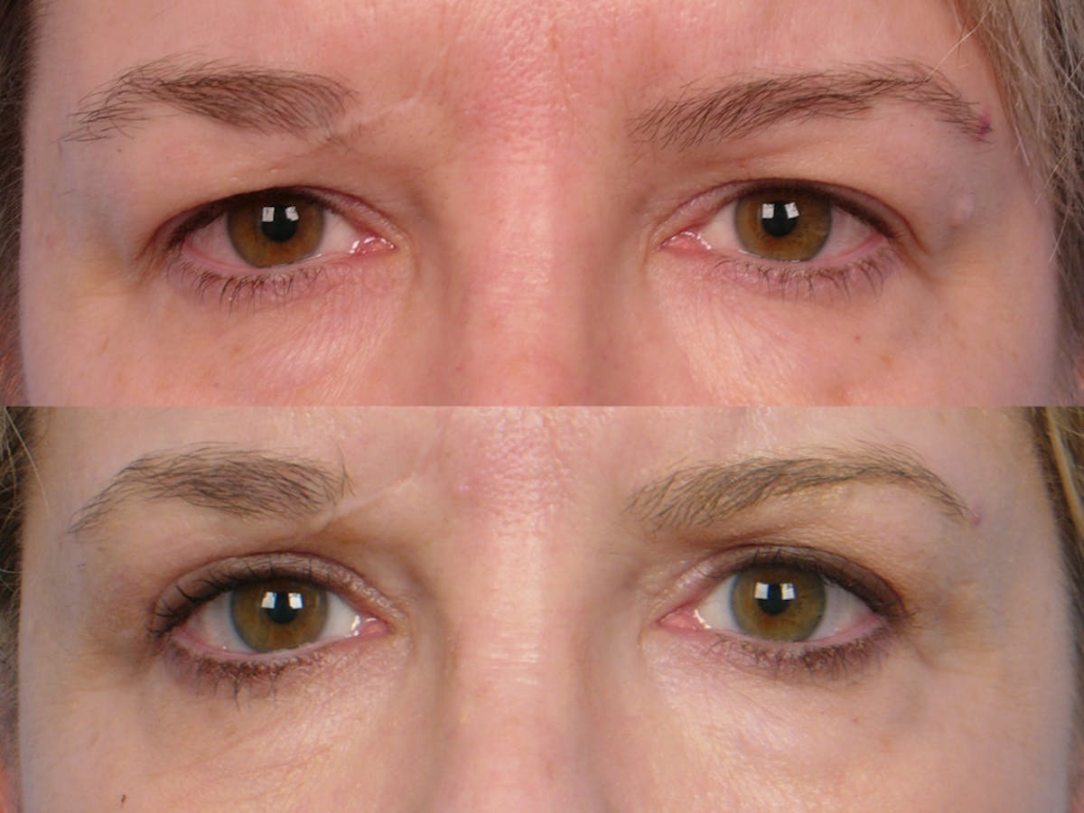 Eyelift Before & After Gallery - Patient 106009273 - Image 1