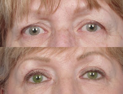 Eyelift Before & After Gallery - Patient 106009274 - Image 1