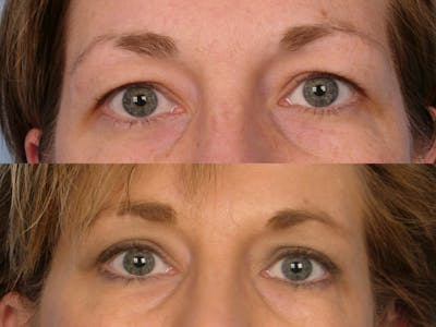 Eyelift Before & After Gallery - Patient 106009275 - Image 1