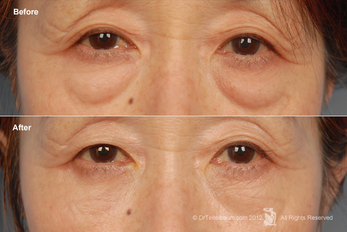 Eyelift Before & After Gallery - Patient 106009276 - Image 1